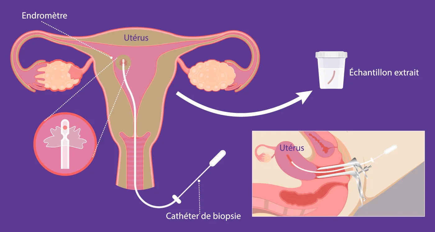 Schéma de la biopsie de l'endomètre développé par IRIFIV Casablanca