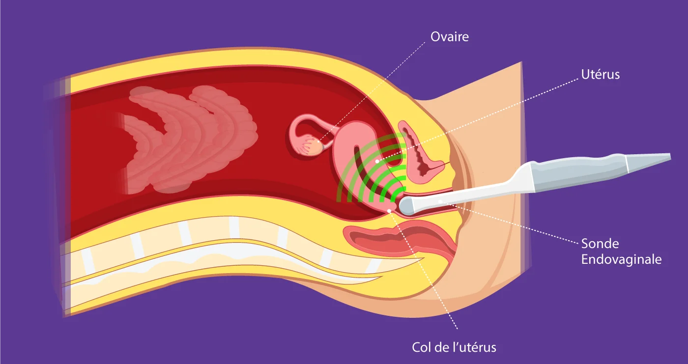 Biopsie de l’endomètre – IRIFIV Casablanca Schéma de l'échographie endovaginale développé par IRIFIV Casablanca