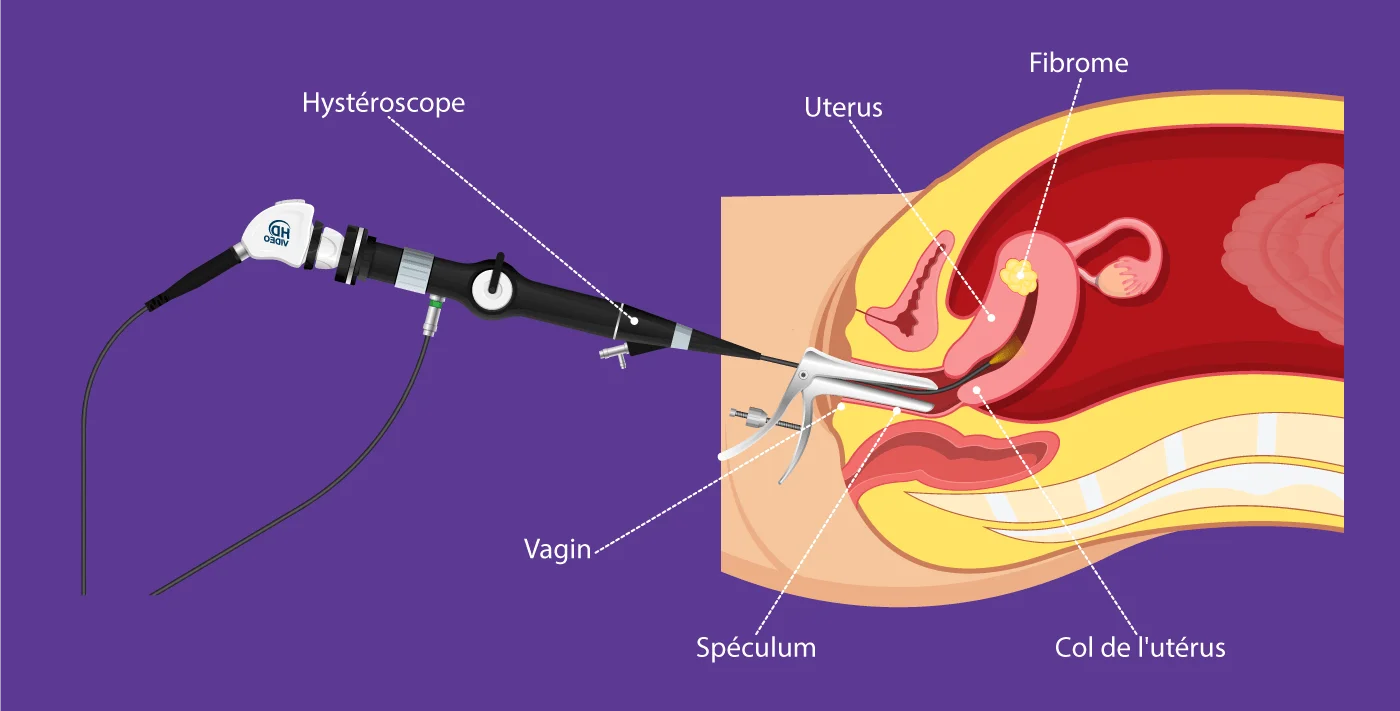 Schéma de l'hystéroscopie diagnostique développé par IRIFIV Casablanca