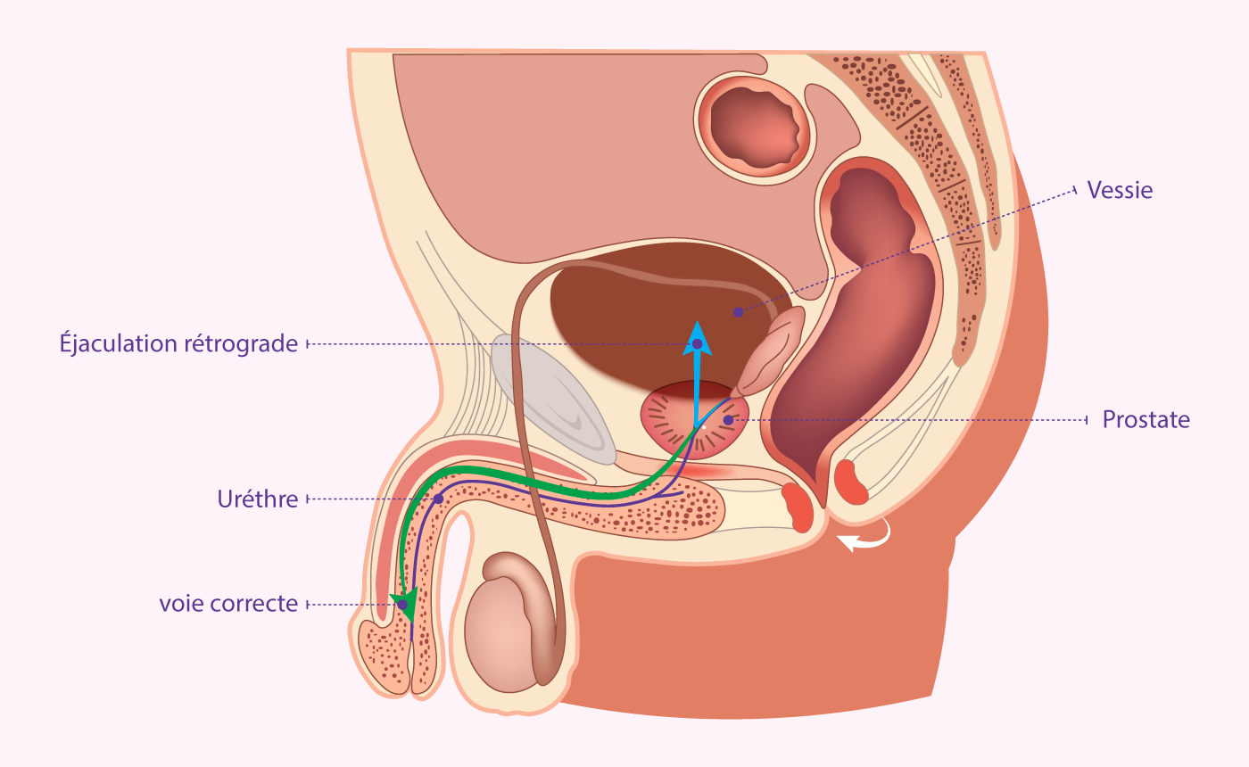 Schéma de l'éjaculation rétrograde développé par IRIFIV Casablanca