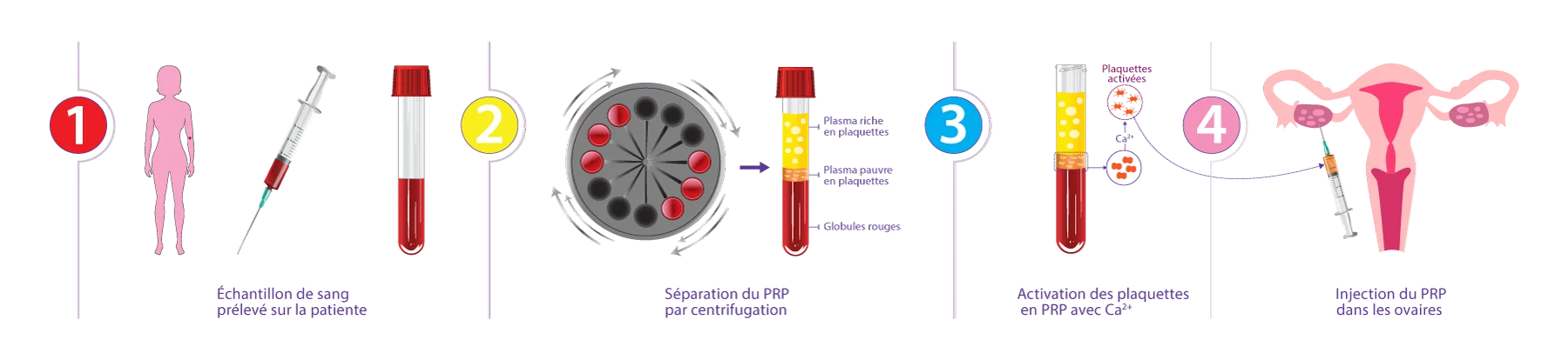 Schéma des étapes du rajeunissement ovarien par PRP développé par IRIFIV Casablanca