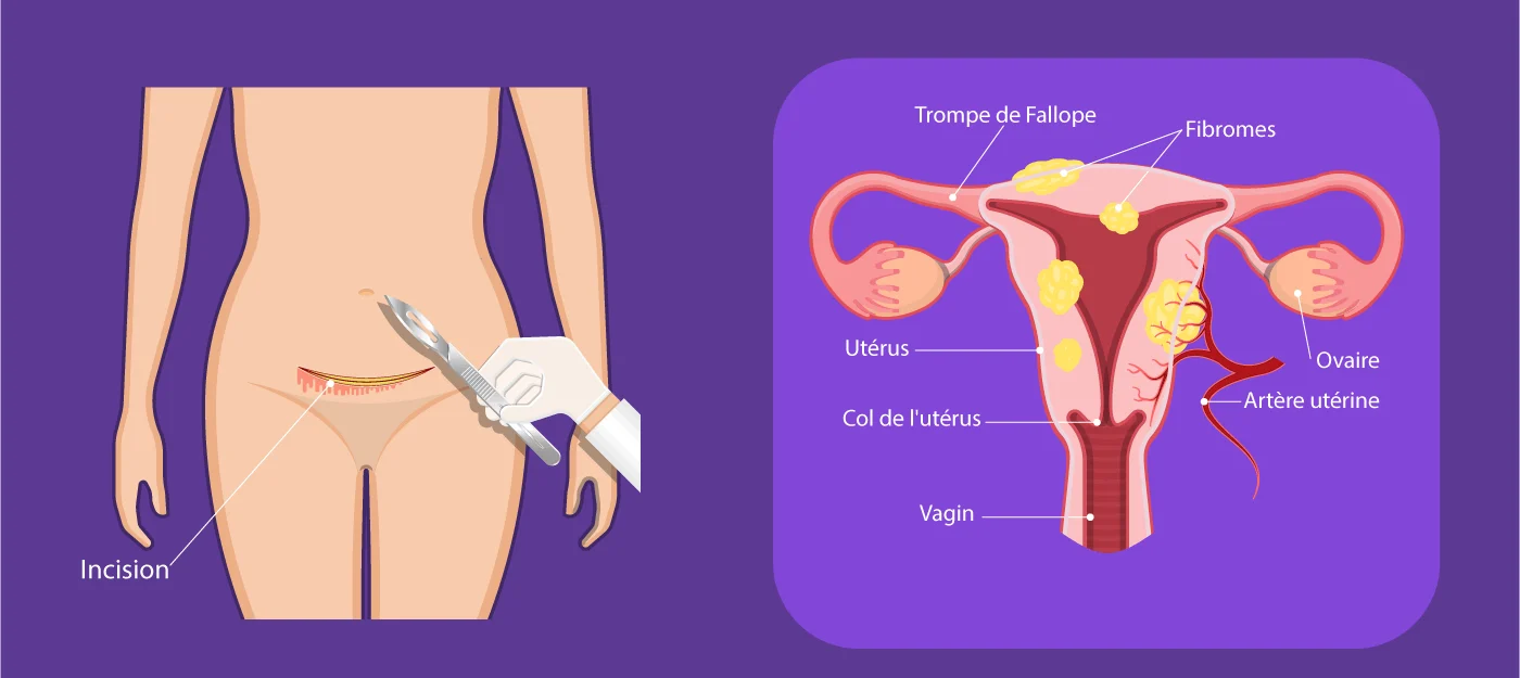 Schéma de la myomectomie abdominale développé par IRIFIV Casablanca