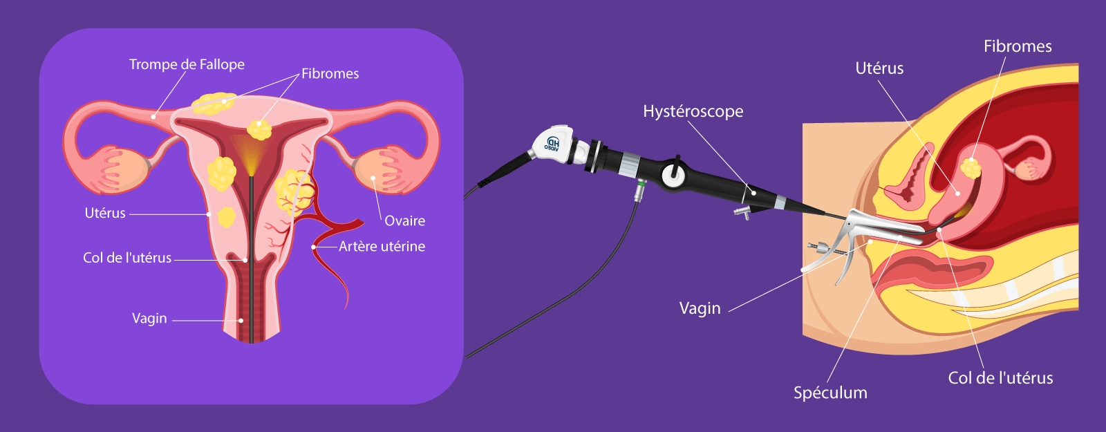Schéma de la myomectomie hystéroscopique développé par IRIFIV Casablanca