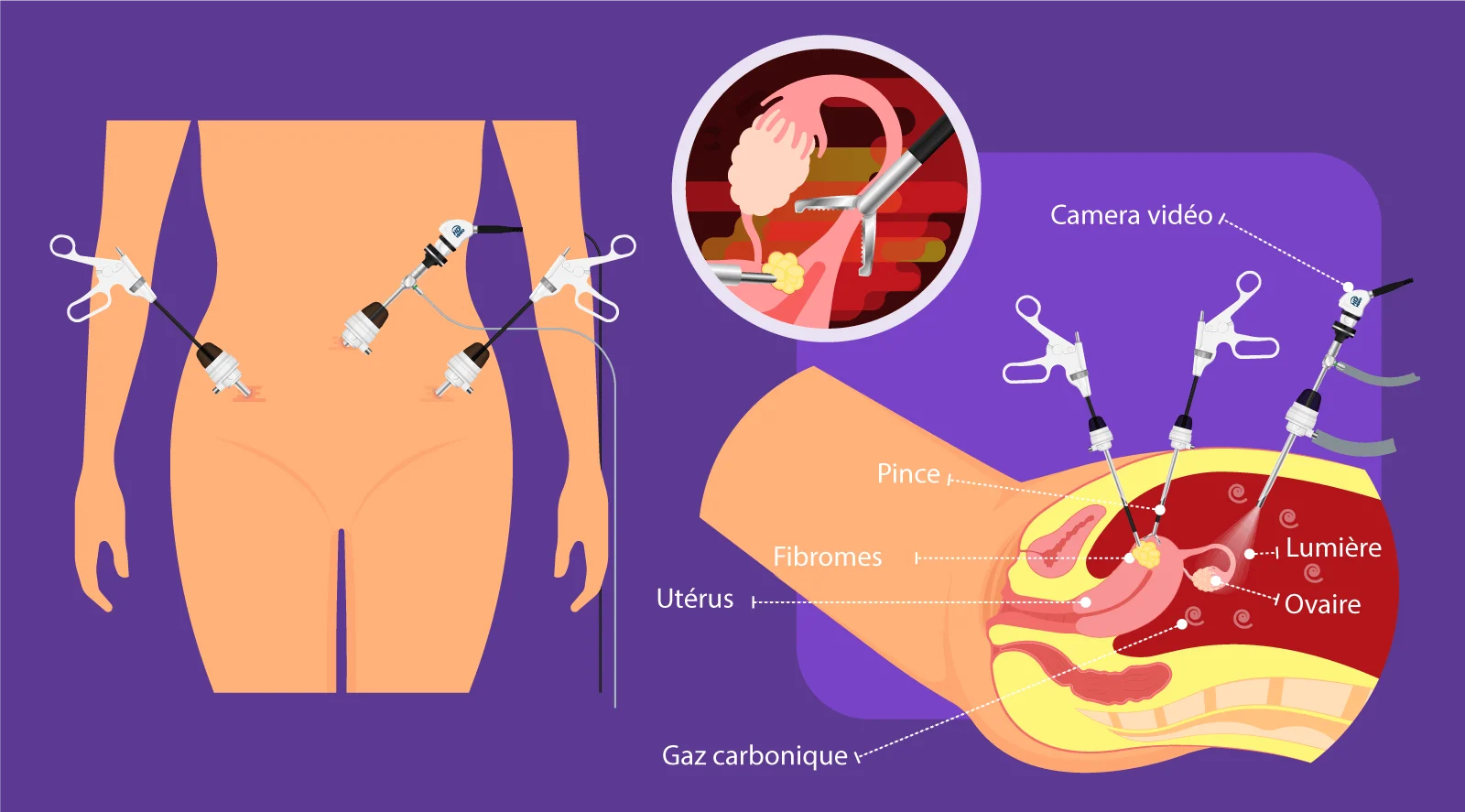 Schéma de la myomectomie laparoscopique développé par IRIFIV Casablanca