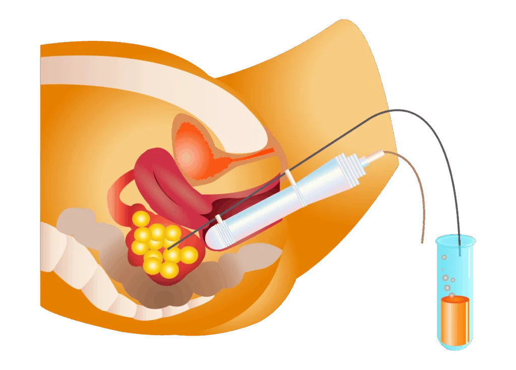 Image illustrant la ponction ovocytaire réalisée avant la vitrification au centre IRIFIV Casablanca