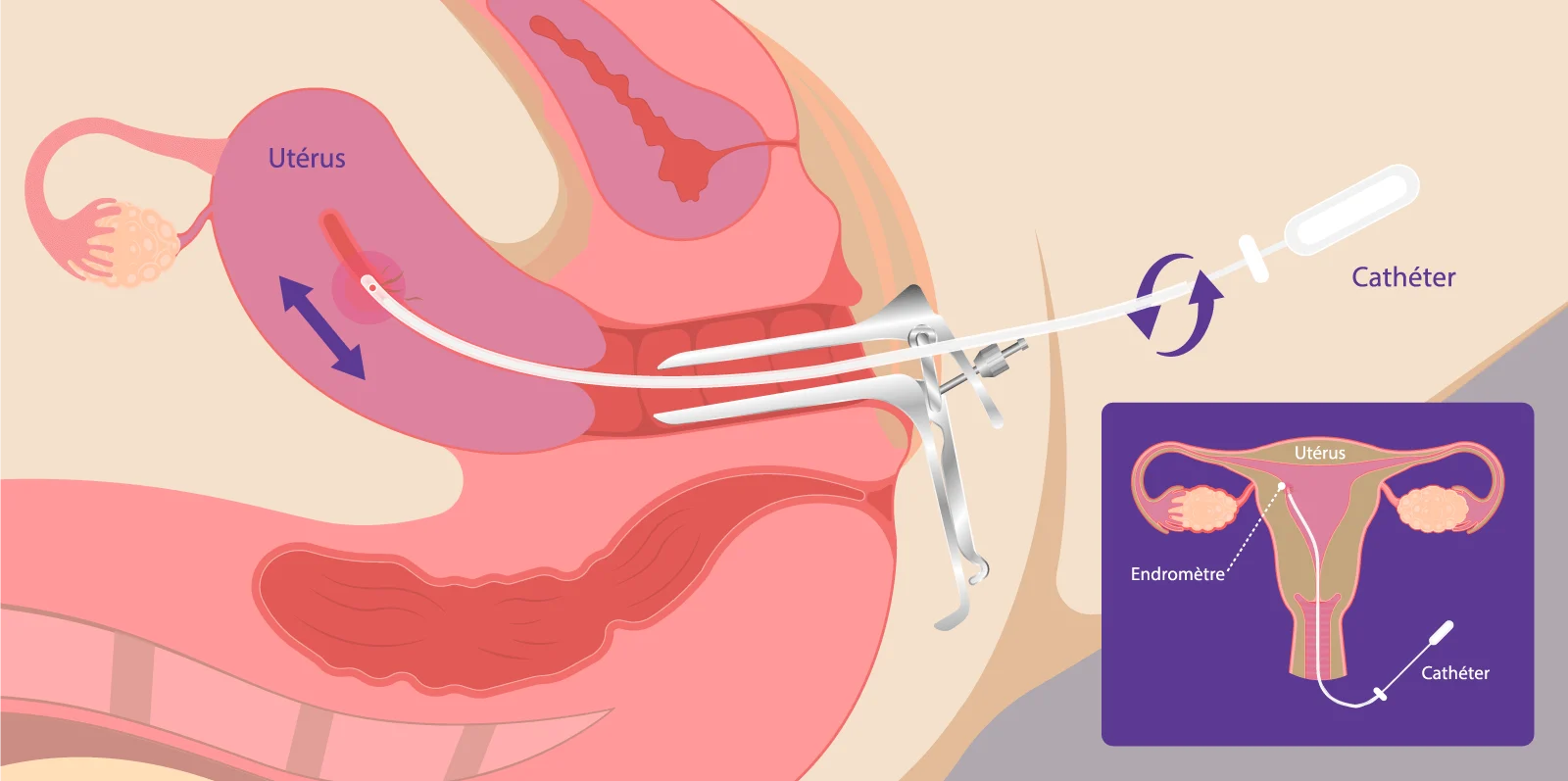 Schéma du scratching endométrial développé par IRIFIV Casablanca