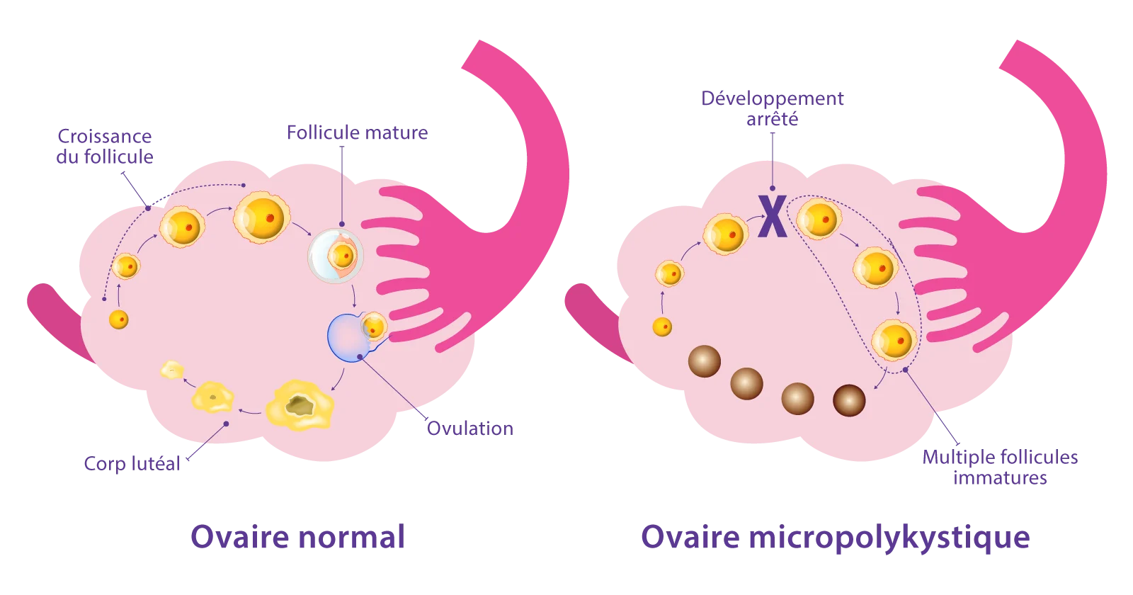 Schéma du syndrome des ovaires micropolykystiques (SOPK) développé par IRIFIV Casablanca