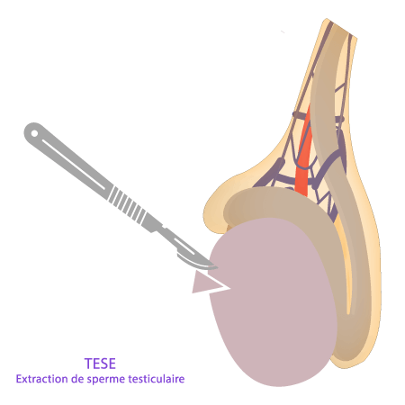Schéma de la technique TESE (biopsie testiculaire) développé par IRIFIV Casablanca