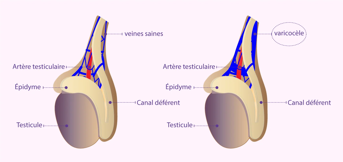 Schéma de la varicocèle développé par IRIFIV Casablanca